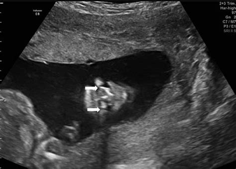 A Cleft Lip Ultrasound