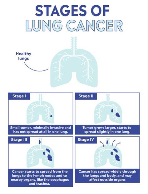 What Is Lung Cancer Symptoms Causes Treatment Prevention