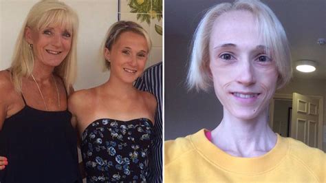 Students Shocking Photos Highlight Anorexia Battle That Left Her