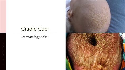 Cradle Cap Infantile Seborrheic Dermatitis Youtube
