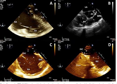 Figure 1 From Preoperative Echocardiography First Diagnosed And