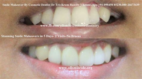 Restore Your Smile And Confidence With Our Life Enhancing Smile