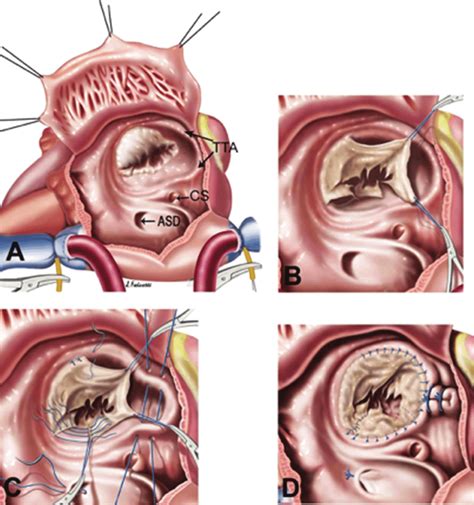 The Cone Reconstruction For Ebstein Anomaly Tricuspid Valve