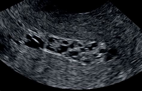 Chapter 6 Sonographic Assessment Of Endometrial Pathology Obgyn Key