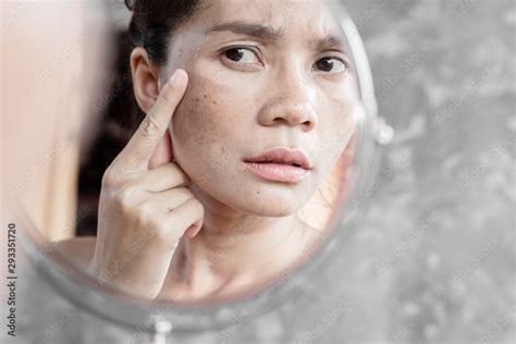 Asian Woman Having Skin Problem Checking Her Face With Dark Spot