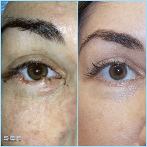 Skin Cancer Reconstruction Before And After Gallery Schlessinger Eye