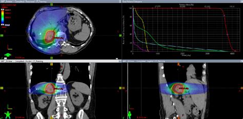 Figure From Stereotactic Body Radiation Therapy Sbrt Of Adrenal Gland Metastases In