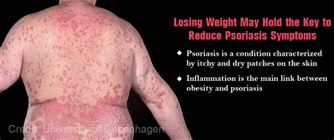 Weight Loss May Show New Hope In The Treatment Of Psoriasis