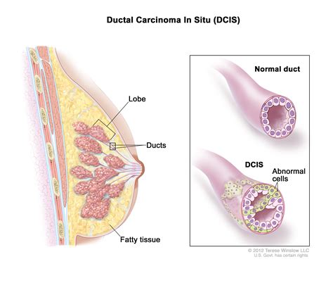 Ductal Carcinoma In Situ Dcis Management And Diagnosis