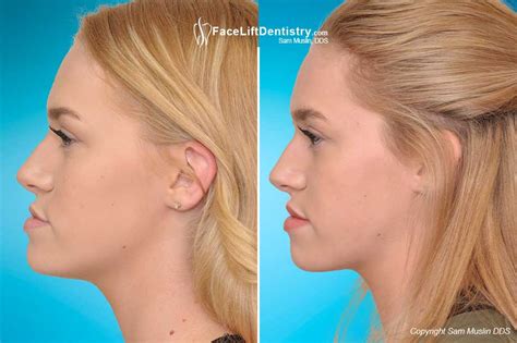 The Ideal Jaw And Tmj Position With Jawtrac Technology