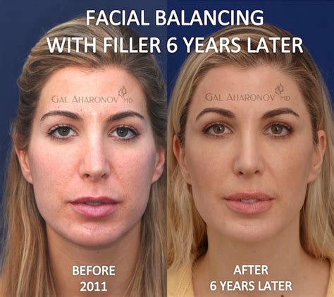 Temple And Forehead Filler Plastic Surgery