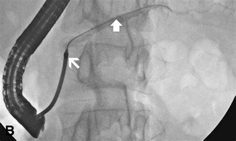 Dilation Of A Severe Pancreatic Stricture By Using A Guidewire Left In