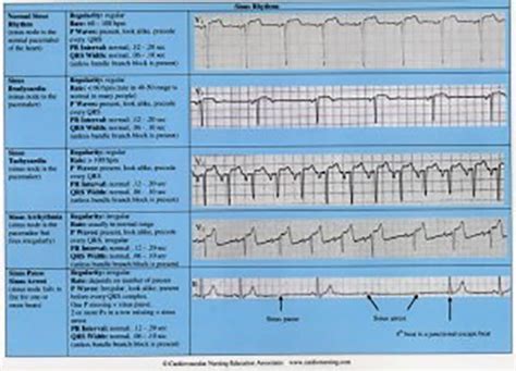 Cardiac Arrhythmias Reference Chart Cardiovascular Nursing Education