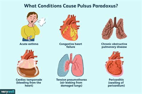 Understanding The Mechanism Of Pulsus Paradoxus