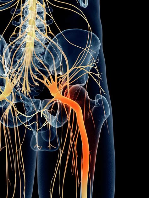 Sciatic Nerve Pain Photograph By Sebastian Kaulitzki Science Photo