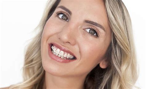 Medfriendly Medical Blog Different Types Of Braces Features Advantages And Disadvantages