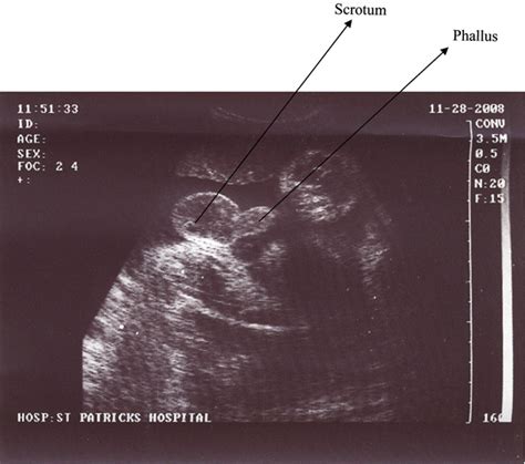 Figure 1 From Sonographic Determination Of Fetal Gender In The Second