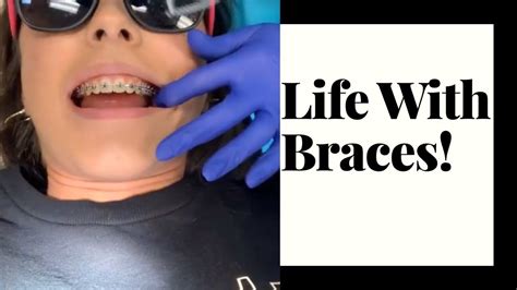 Life With Braces 😁 Youtube
