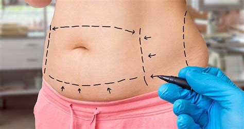 How Much Does A Tummy Tuck Cost