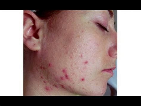 Dry Skin And Acne What Acne Treatment To Use And How To Manage It
