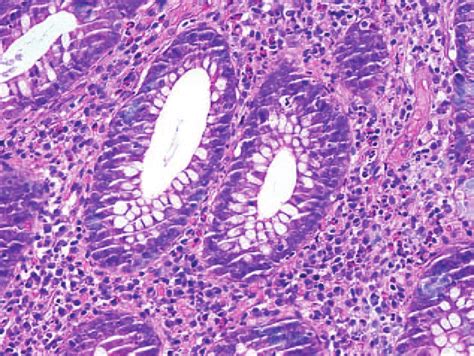 The Histopathological Findings In A Specimen From The Colon Obtained