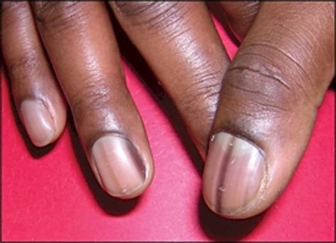 Professionally performed and dark vertical lines in toenails pattern on nails can be done not only with the help of brushes, but also with the help of dots. 7 Things Your Nails Can Tell You About Your Health | The ...
