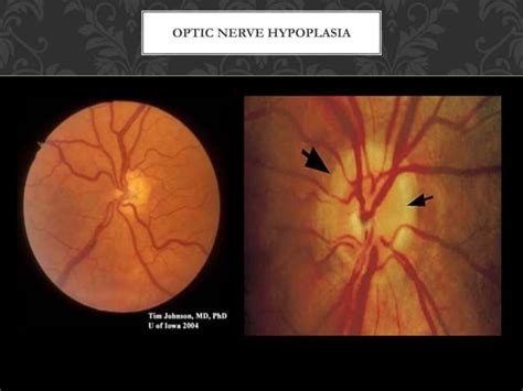 Congenital Malformation Of Optic Nerve And Choroid