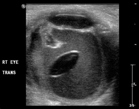 Traumatic Lens Dislocation Radrounds Radiology Network