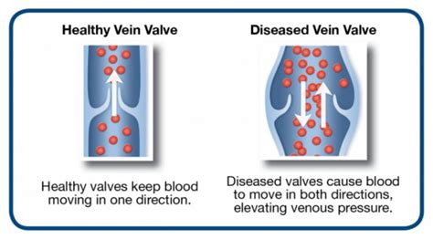 What Are Vein Problems Atlas Vein Care