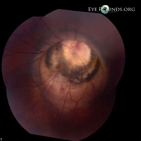 Atlas Entry Morning Glory Disc Anomaly With Peripapillary Staphyloma