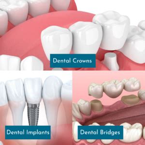 Crowns And Bridges On Implants And Natural Teeth Dr Chang