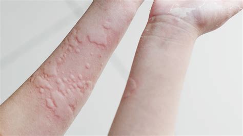 Itchy Bumps On Skin Like Mosquito Bites Seedsyonseiackr