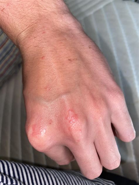 has anyone experienced similar bumps like this while on accutane have them on both hands r