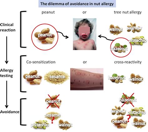 Managing Nut Allergy A Remaining Clinical Challenge The Journal Of