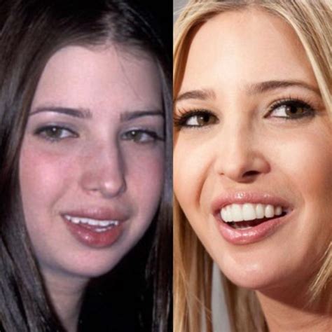 Before And After All Ivanka Trumps Plastic Surgeries And Cosmetic