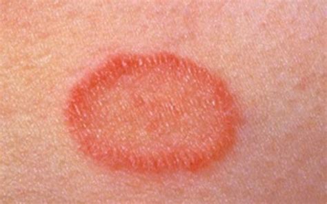 How To Get Rid Of Pityriasis Rosea Naturally With Home Remedies