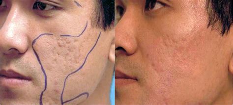 Face Laser Treatment For Acne Scars