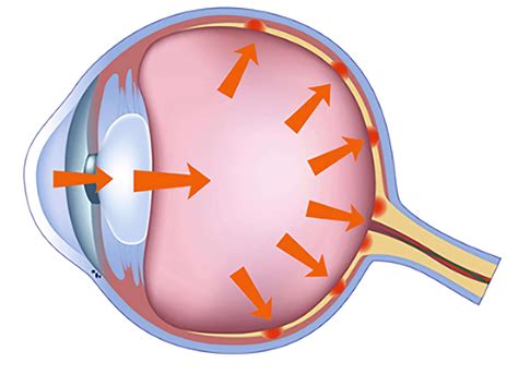 Understanding Glaucoma Eye Tech Care