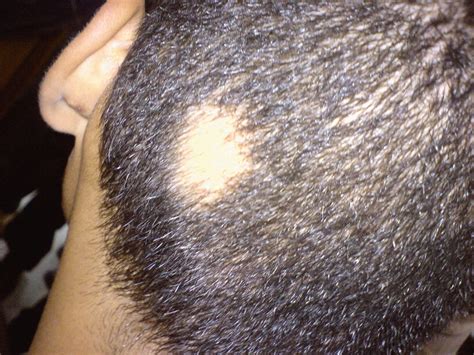 Alopecia Areata Causes Symptoms And Treatment Options