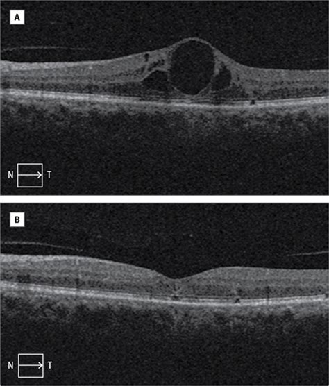 Intravitreal Fasudil Combined With Bevacizumab For Persistent Diabetic