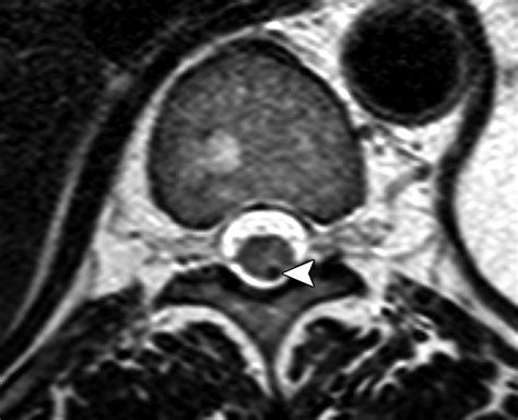 Airp Best Cases In Radiologic Pathologic Correlation Spinal Conus