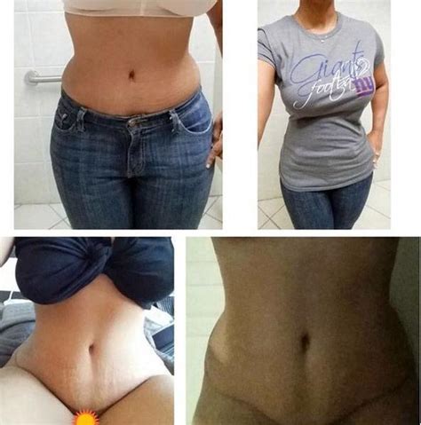 Tummy Tuck Before And After Pics Scar Tummy Tuck Prices Photos