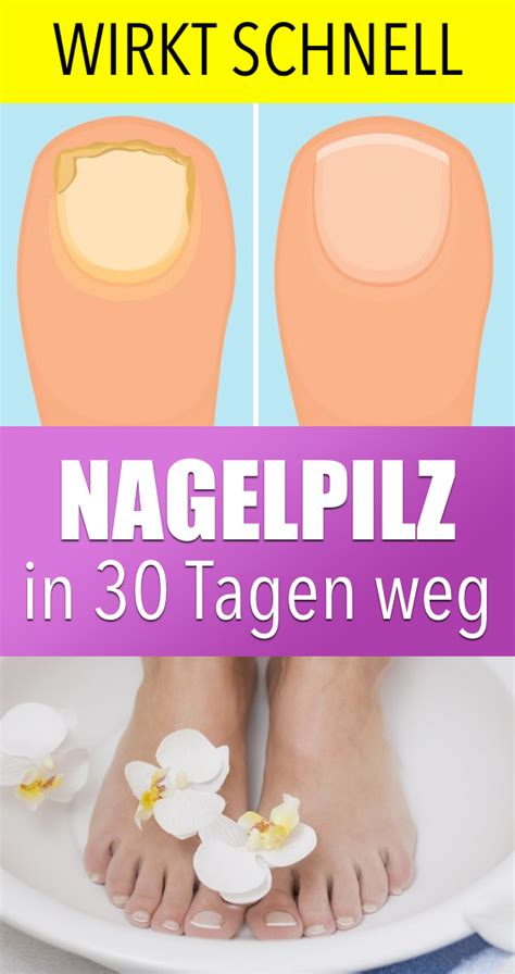 Nagelpilz Adé Schnell Und Dauerhaft Nagelpilz Unter 30 Tagen