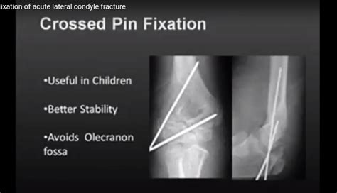 Acute Lateral Condyle Fractures In Children —