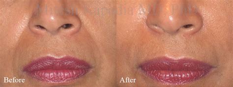 Fillers For Nasolabial Folds And Smile Lines Boston Eyelids