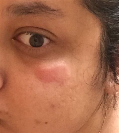 Bed Bug Bites On Face