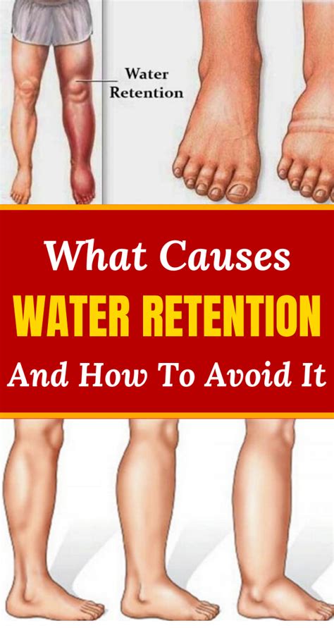 What Causes Water Retention And How To Avoid It Holistic And Healthy