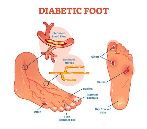 Diabetic Foot Care Tips Preferred Foot Ankle