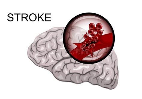 Hemorrhagic Stroke Insult Rupture Of The Vessel Stock Vector