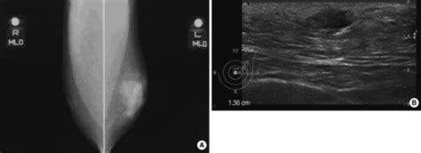 Figure 1undifferentiated Pleomorphic Sarcoma Of The Male Breast